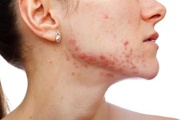 How To Treat Acne & Types Of Acne To Get Rid Effectively.