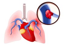 How to Manage Pulmonary Embolism